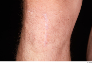 Trent knee nude scar 0002.jpg